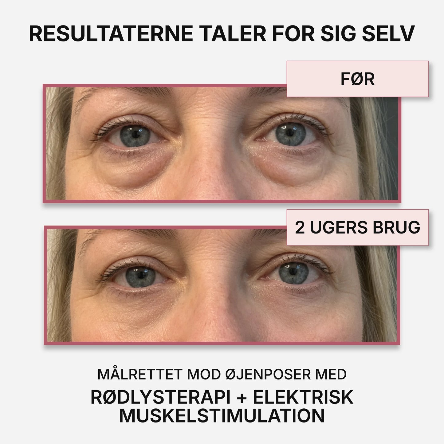 VividEyes™ 2-i-1 Rødlysterapi + EMS til at fjerne øjenposer