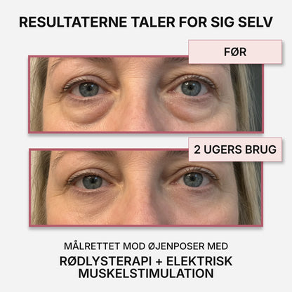VividEyes™ 2-i-1 Rødlysterapi + EMS til at fjerne øjenposer